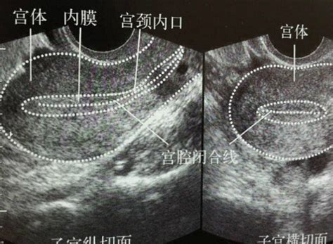 子宫内膜息肉100%复发