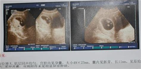 怀孕11周胎儿b超图结果图