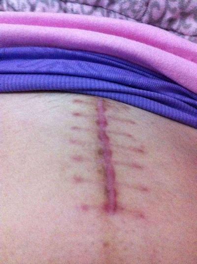 剖腹产疤痕5年了怎么修