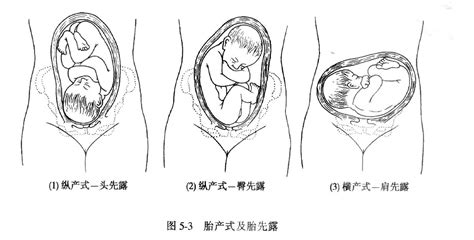 32周胎位显示臀位