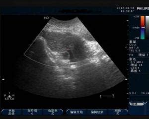 盆腔积液反反复复发作怎么办