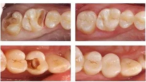补牙流体树脂和固体树脂区别