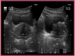 胎儿缺氧超声诊断标准