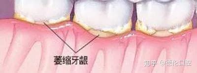 老人牙床萎缩严重还能戴假牙吗