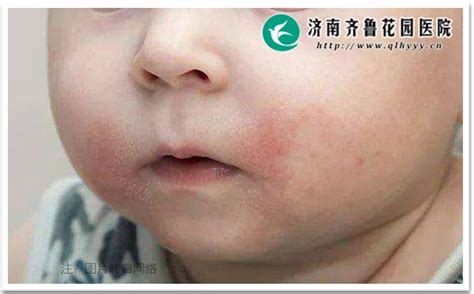 如何预防夏季儿童过敏