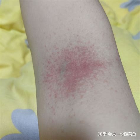 宝宝吃鱼过敏了几天会好 宝宝吃鱼过敏几天能好