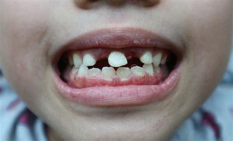 两岁小孩牙黑是什么原因引起