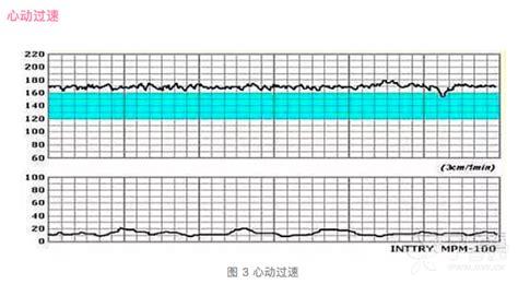 胎心监护发现胎心过快