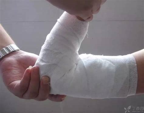 取钢钉手术亲身经历