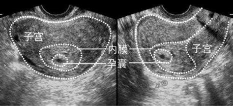 孕早期孕囊旁有积液怎么办