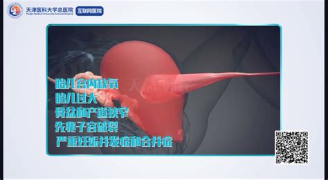 中骨盆狭窄可以顺产吗