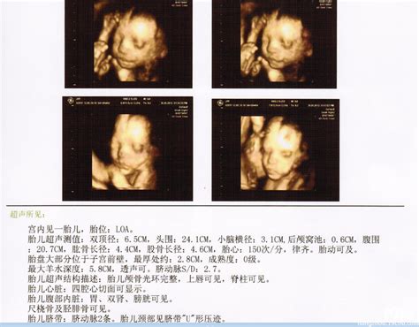 11周胎儿彩超图片