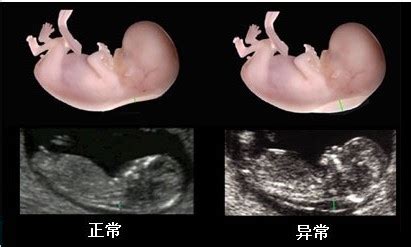 孕期检查宝宝是畸形,