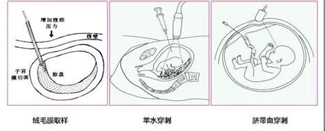 胎儿染色体非整倍体无创基因检测是唐氏筛查吗