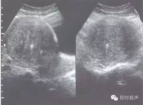 子宫腺肌症怀孕能治愈吗