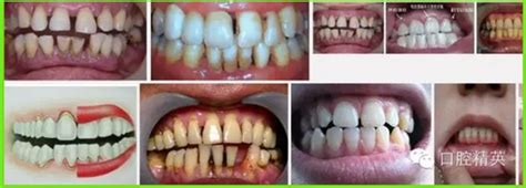 牙龈萎缩是什么原因引起的