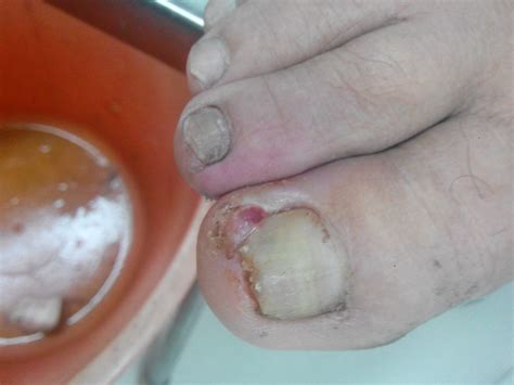 甲沟炎长肉芽怎么办?