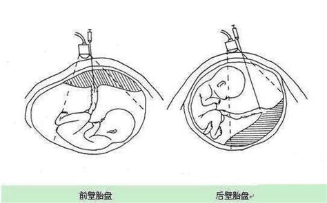 怀孕子宫前位和后位有啥区别