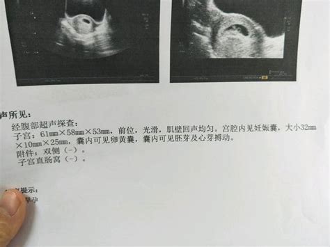 怀孕5周有胎芽正常吗