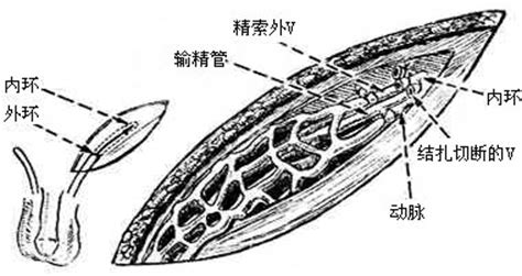 精索静脉曲张手术方式及各种优点