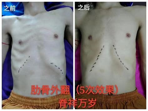 胸肋骨畸形矫正手术