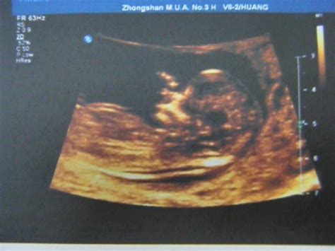 怀孕2周6检查b超报告图片