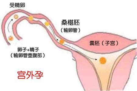 宫外孕微创三个月了