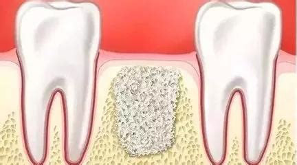 拔牙后多长时间种植牙合适