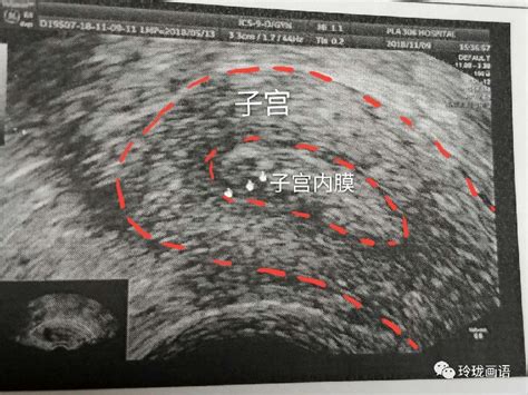 子宫大小约54mmx35mm正常不