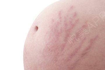 孕期乳房会长妊娠纹吗