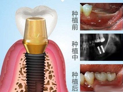 种牙多少钱一颗便宜