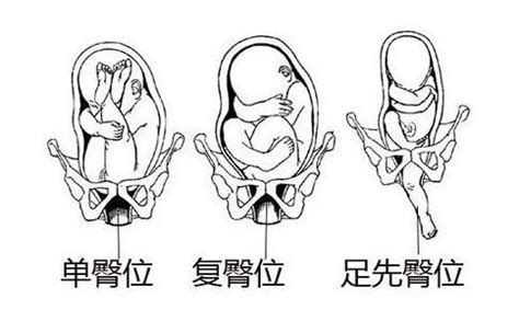 24周胎儿臀位正常吗