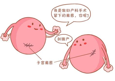 产后容易子宫脱垂吗