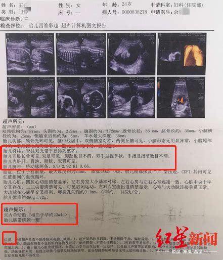 孕妇b超催尿的7种方法