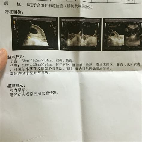怀孕6周能看到胎心胎芽没