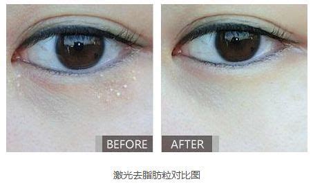 眼部脂肪颗粒照片