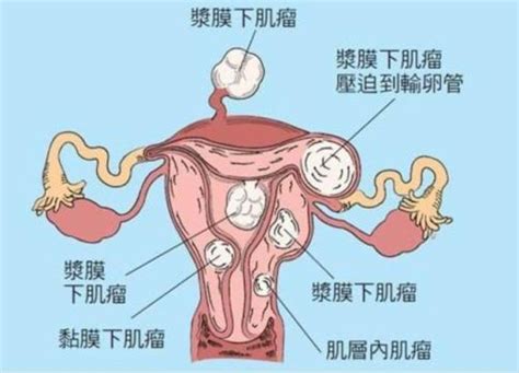 宫颈妊娠的症状有哪些表现