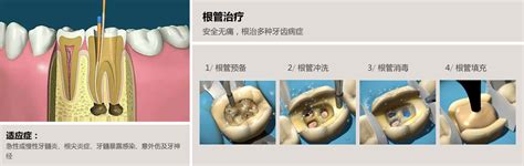 广州口腔医院种植牙价格表