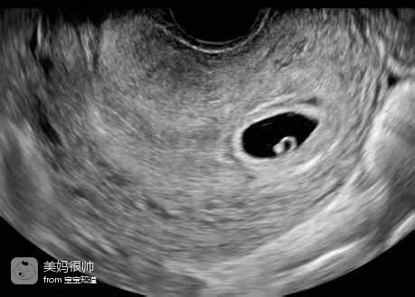 6周孕囊是长条的有胎心