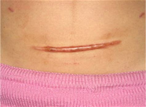 剖腹产横疤痕纹身图片,女人剖腹产后肚子很丑