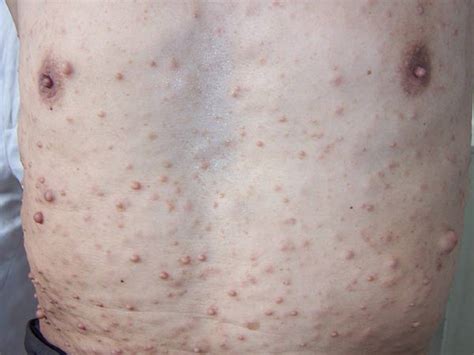 神经纤维瘤是怀孕期间导致的吗