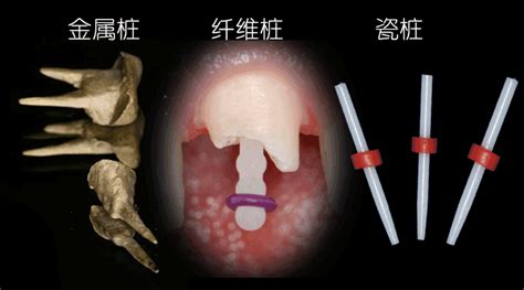 栽桩牙齿固定方法