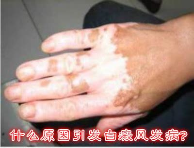 什么是冻伤？