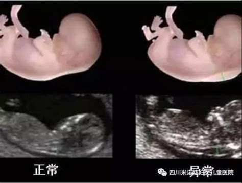胎儿镜检查是什么意思