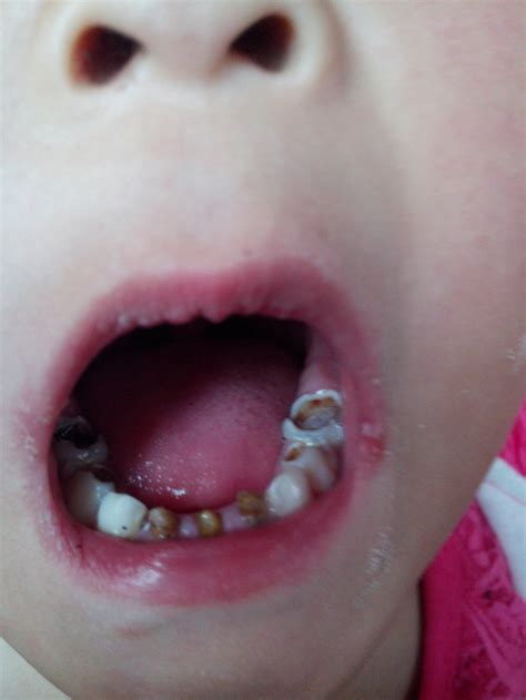 小孩拔牙多久才长新牙
