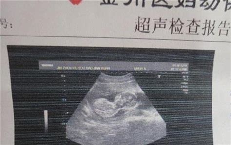 孕囊大小就是胎儿大小吗
