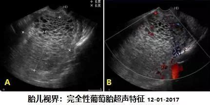 什么是葡萄胎,葡萄胎是怎样形成的,它有什么特征?