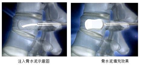 骨质增生手术后多久可以走路