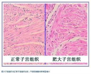 绝经后子宫萎缩会导致什么病