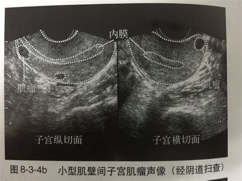 子宫后位5.2*5.2*4.4正常吗